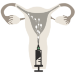 Home insemination - Carrying out insemination - Cup method