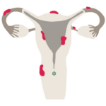 Diagram: Pregnant despite endometriosis