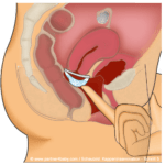 Schritt 5 - Kappe mit Sperma einsetzen - Heiminsemination / Kappeninsemination