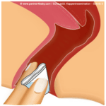 Step 3 - Insert cap for test - home insemination / cap insemination