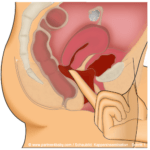 Schritt 1 - Muttermund abtasten - Heiminsemination / Kappeninsemination