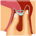 Schritt 4 - Kappe richtig platzieren - Heiminsemination / Kappeninsemination