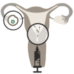 03 - ICI - Intracervical Insemination - Intracervical Insemination