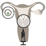 03 - ICI - Intracervical Insemination - Intrazervikale Insemination