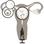 06 - IUTPI - Intrauterine Tubo Peritoneal Insemination