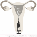 Diagram: Home insemination / cup method