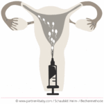 Schaubild: Heiminsemination / Bechermethode