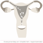 Diagram: Cap insemination