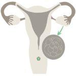 Ovarian changes - Pregnancy despite PCO?